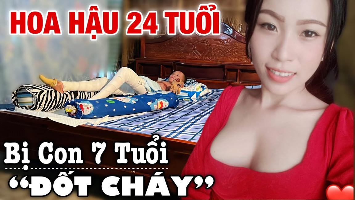 Xót xa Hoa Hậu “Cháy Bỏng” 24 tuổi đẹp nhất Làng, giờ ra nổng nổi này đây.!